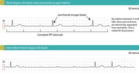 Management and treatment of AV block (atrioventricular blocks) – ECG ...