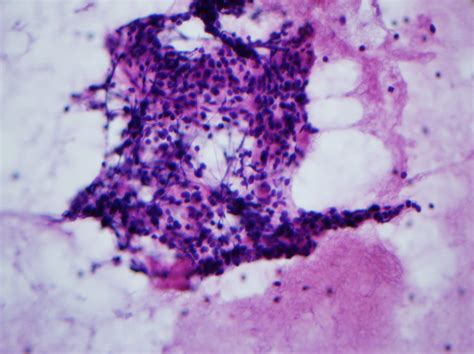 Pathology Outlines - Accessory