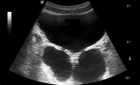 Using Point of Care Ultrasound for Bladder Diagnosis