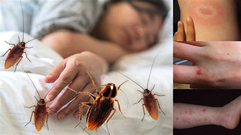 How Do You Know If A Roach Bite You? The 18 Detailed Answer - Chiangmaiplaces.net