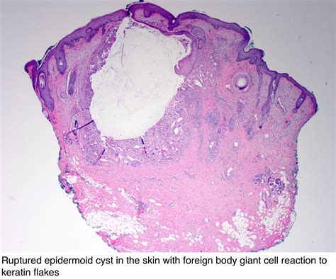 Pilar Cyst Histology