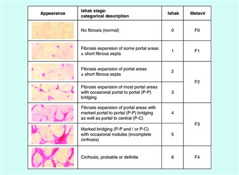 Liver Fibrosis Scale