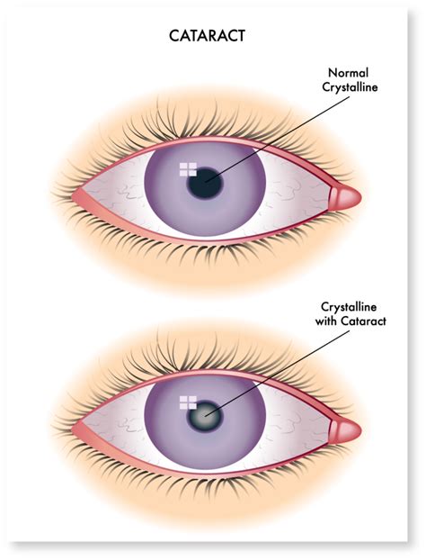 Cataract Symptoms | 1960 Eye Surgeons | Houston