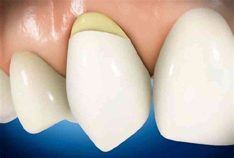 Dental Abrasion: What is it and do You Need it? - Ascent Family Dental