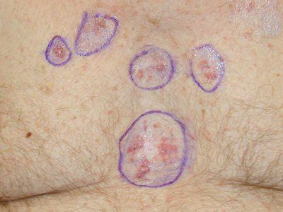 Pictures of skin cancer: Skin cancer symptoms images