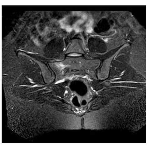 MRI T2 axial scan showed bone marrow edema at the sacrum. | Download Scientific Diagram