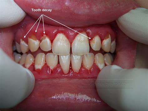 Tooth decay | Ask Your Dentist