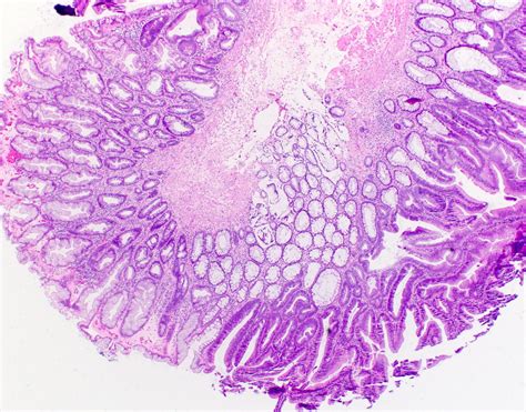 Sessile Polyp Histology