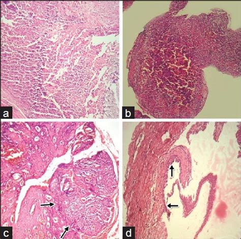 Periapical Abscess Histology