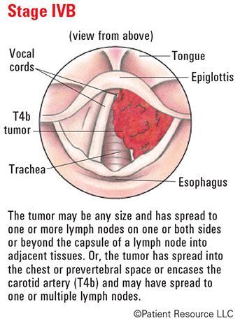 Head & Neck Laryngeal Cancer