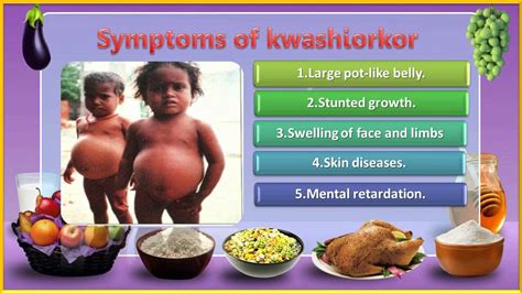 04 Nutrition and their Deficiency Diseases 5th evs - YouTube