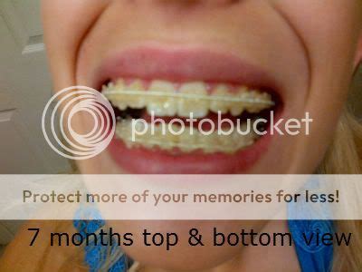 Before And After Braces: Buck Teeth Before And After Braces Pictures