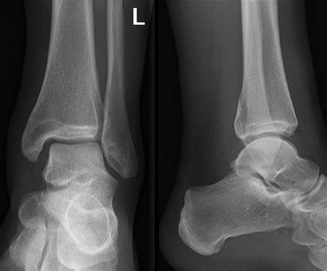 Mortise and Lateral View X-ray of Left Ankle. Mortise and lateral view... | Download Scientific ...