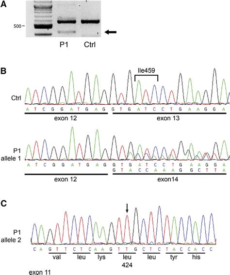 The Splice-Site Mutation in Proband 1 Results in Skipping of Exon 13,... | Download Scientific ...