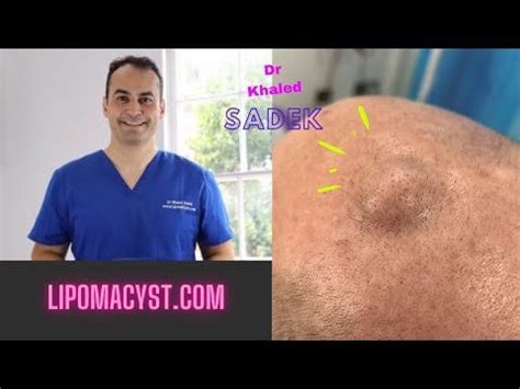 Massive Pilar cyst removal : r/Popping_Curated