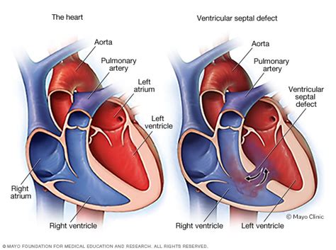 Ventricular septal defect (VSD) - Symptoms and causes - Mayo Clinic