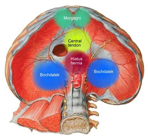 Congenital Diaphragmatic Hernia Types