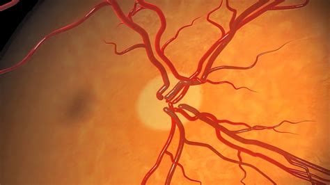 What Causes Optic Nerve Damage?