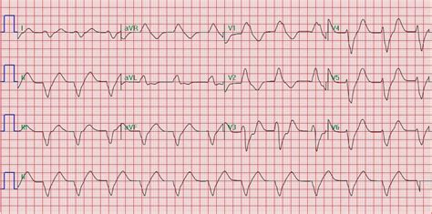 Sine Wave Pattern Ecg | Images and Photos finder