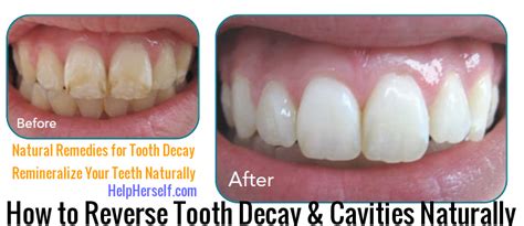 How to Remineralize Teeth, Reverse Tooth Decay Naturally - HelpHerself.com