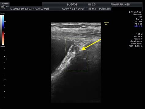 Ultrasound diagnosis of bladder endometriosis [Dec 2022] – EFSUMB