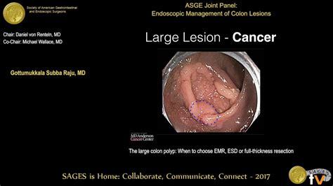 Large Colon Polyps