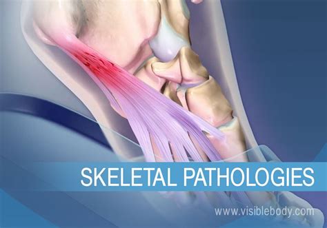 Skeletal System Pathologies