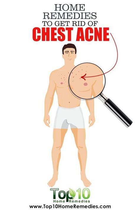 Home Remedies To Get Rid of Chest Acne