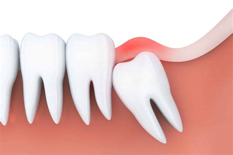 Wisdom Teeth Removal Recovery Time: How Long Does it Take?