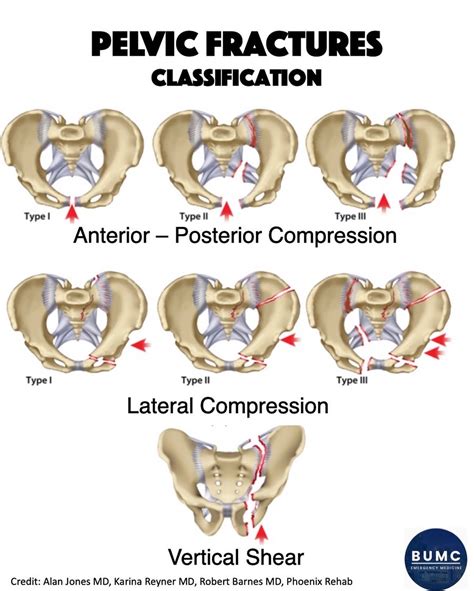 Pelvic Fractures 2 - BUMCEM