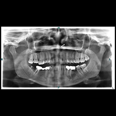 Periapical cyst | Radiology Case | Radiopaedia.org