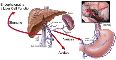 Congenital hepatic fibrosis causes, symptoms, diagnosis, treatment & prognosis