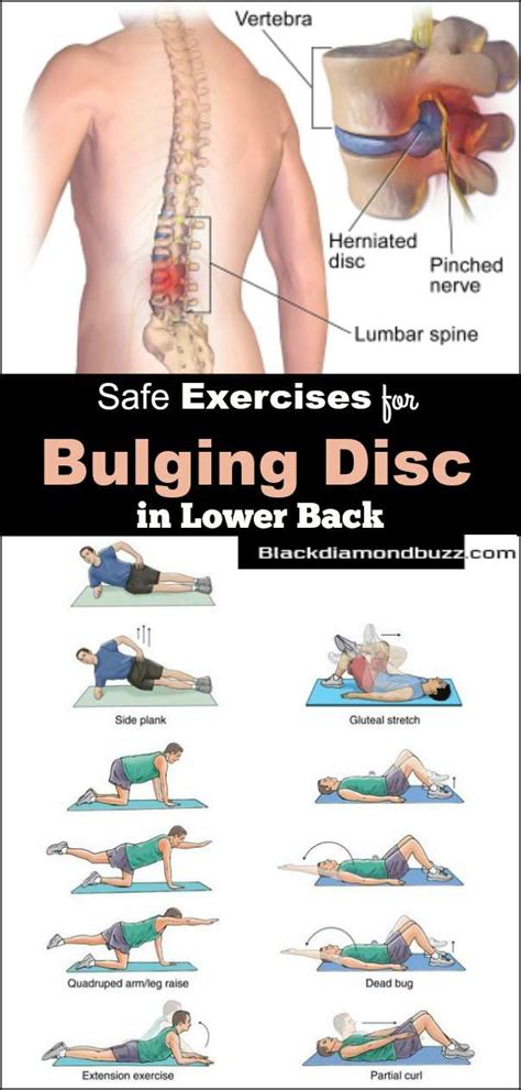 Herniated Disc Exercises for Fast Results- Lower Back Pain Relief