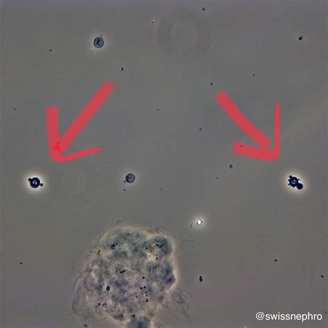 Rbc Cell In Urine