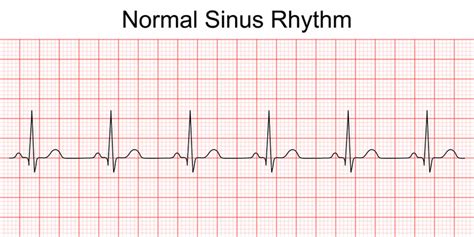 Normal 12 Lead Ecg Labeled