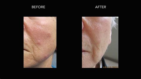 Mole Removal: Before & After Photos | DermMedica