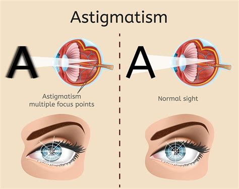 Lasik Eye Surgery Cost for Astigmatism | Excel Eye