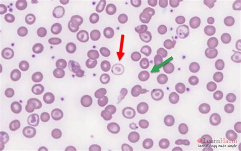 Dimorphic Picture - LearnHaem | Haematology Made Simple