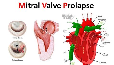 Mitral Valve