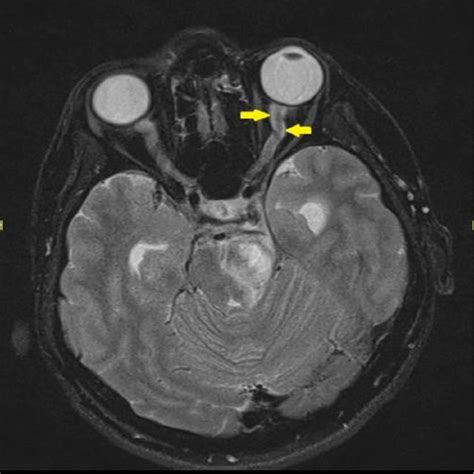 Magnetic resonance imaging (MRI) showed kinked left optic nerve with... | Download Scientific ...