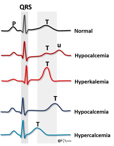 Hypokalemia Ecg