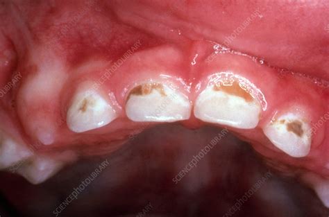 Baby Bottle Tooth Decay - Stock Image - C030/5528 - Science Photo Library