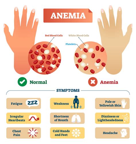 Iron Deficiency Anemia Symptoms