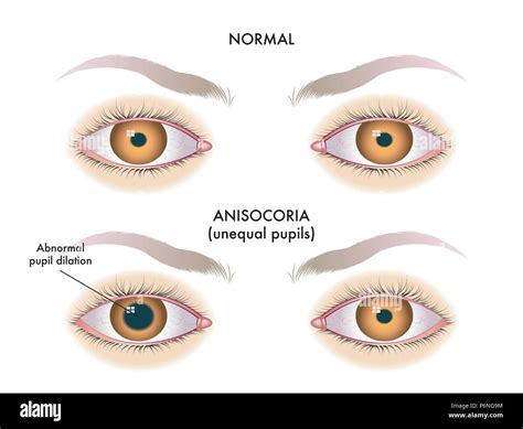 Miosis Y Midriasis