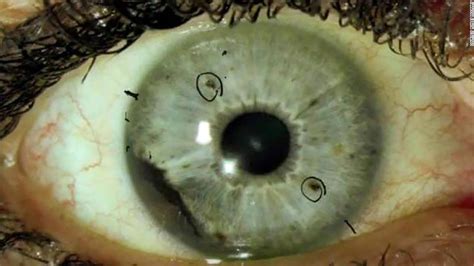 Group of rare eye cancer cases baffles experts - CNN