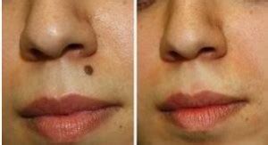 Mole Removal Pictures