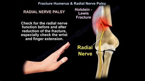 Fracture Humerus and Radial Nerve Palsy — OrthopaedicPrinciples.com