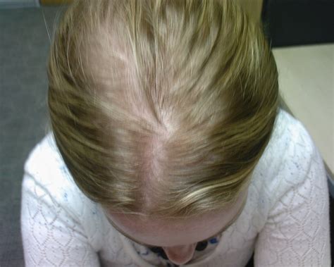 The Hair Loss Centre | FEMALE HAIR LOSS (ANDROGENETIC ALOPECIA) RESULTS