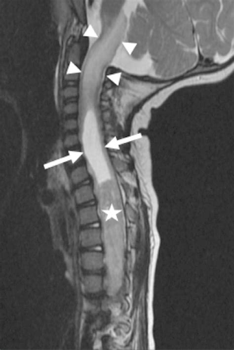 MRI showing Spinal Cord Tumor in a Child - Dr Prem Pillay