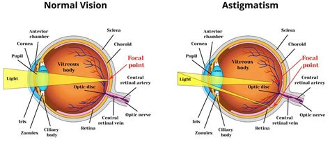 What is Astigmatism? What Does it look Like? LasikPlus